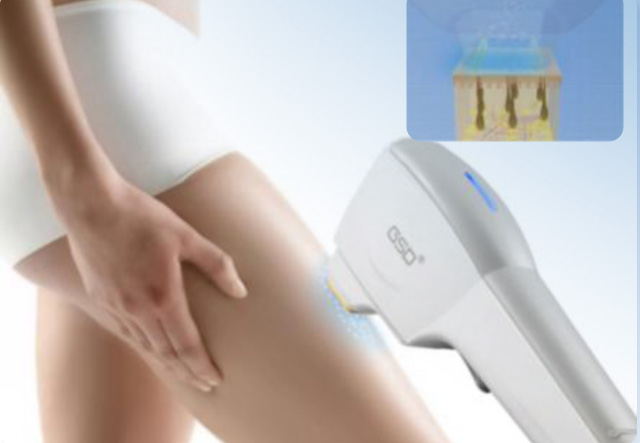 Modernste Diodenlaser liefern beste Resultate. Sicher und schmerzarm.